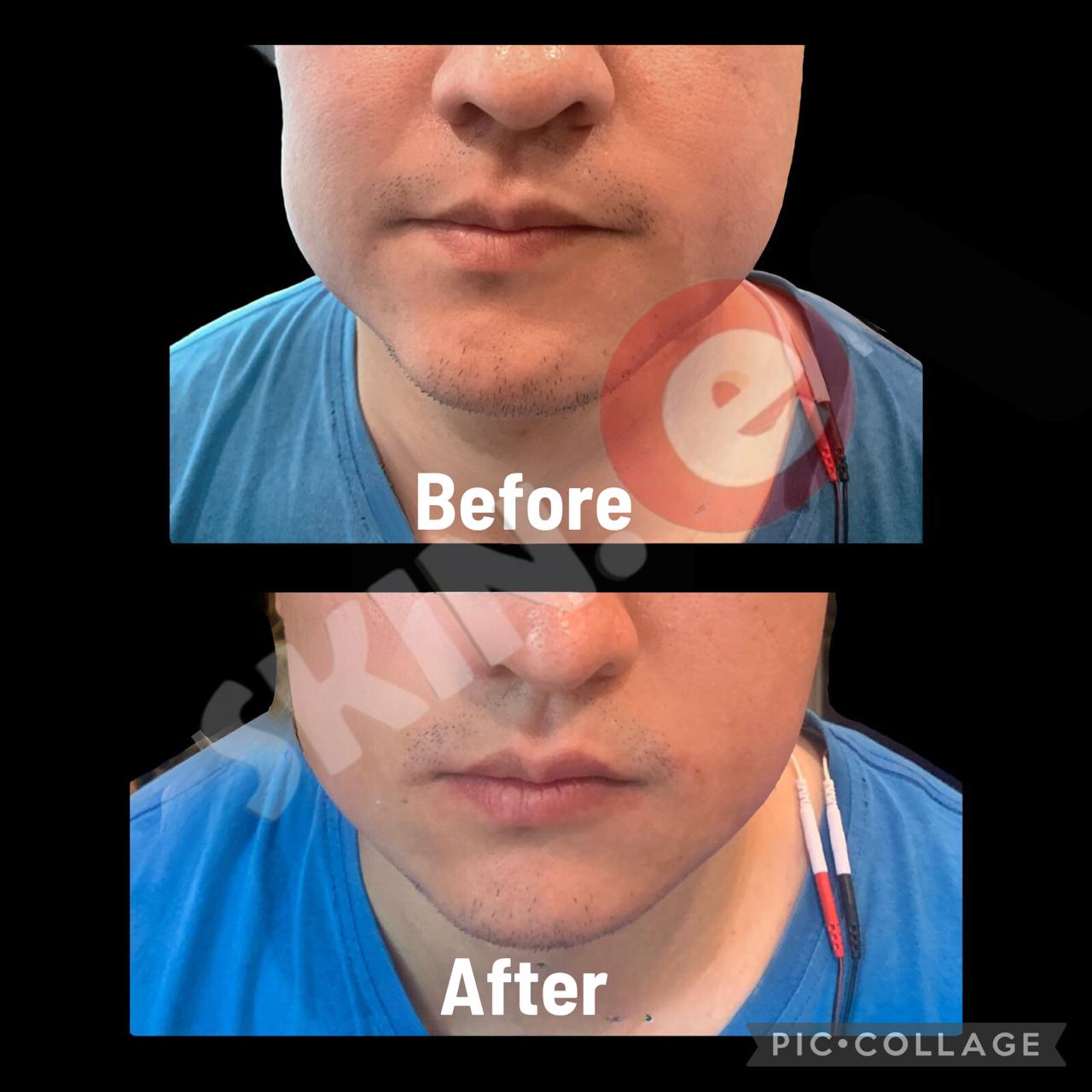 Chin Filler Lip Booster